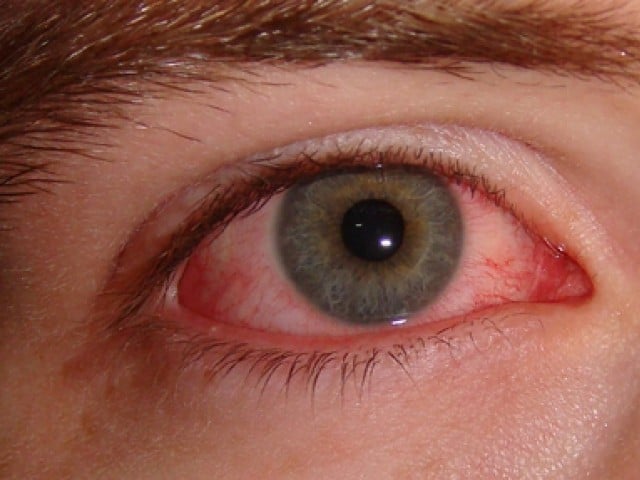 punjab-schools-on-high-alert-as-conjunctivitis-spreads-rapidly