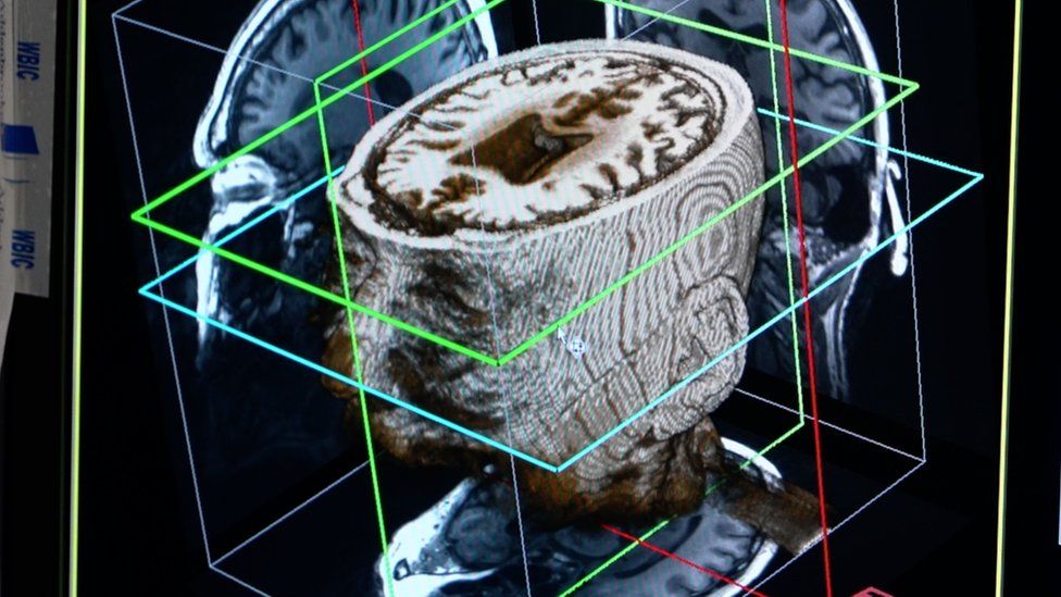 after-single-brain-scan-artificial-intelligence-may-diagnose-dementia-in-a-day